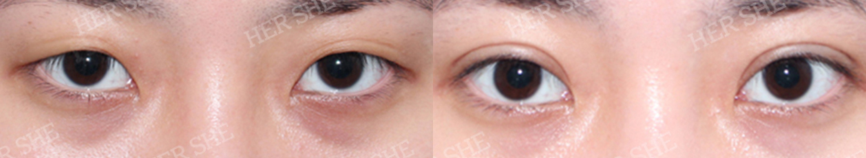 eye surgery Before&After