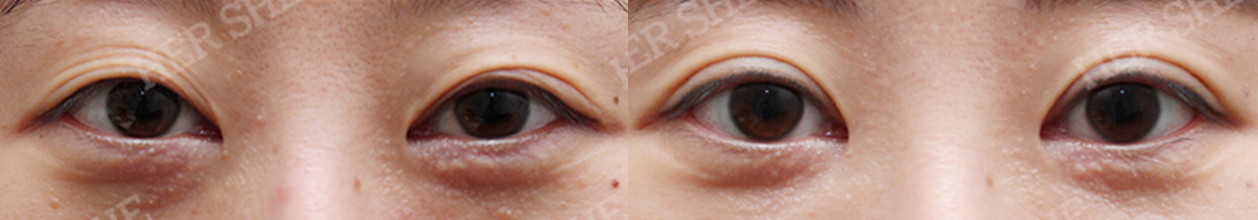 eye surgery Before&After