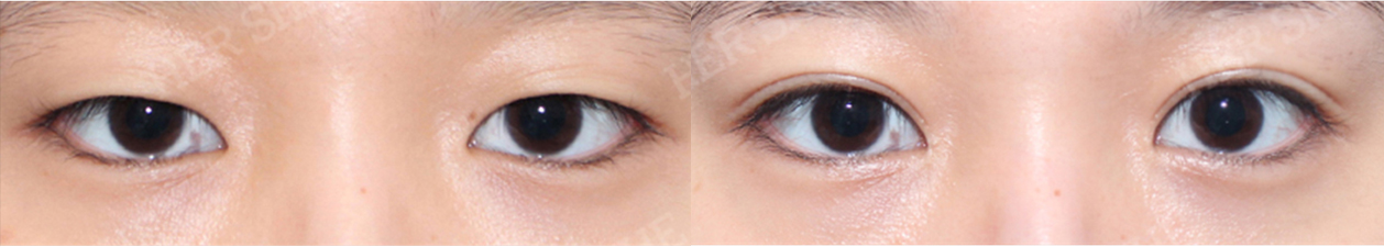 eye surgery Before&After