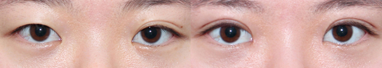 eye surgery Before&After