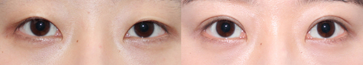 eye surgery Before&After