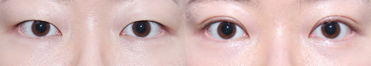 eye surgery Before&After