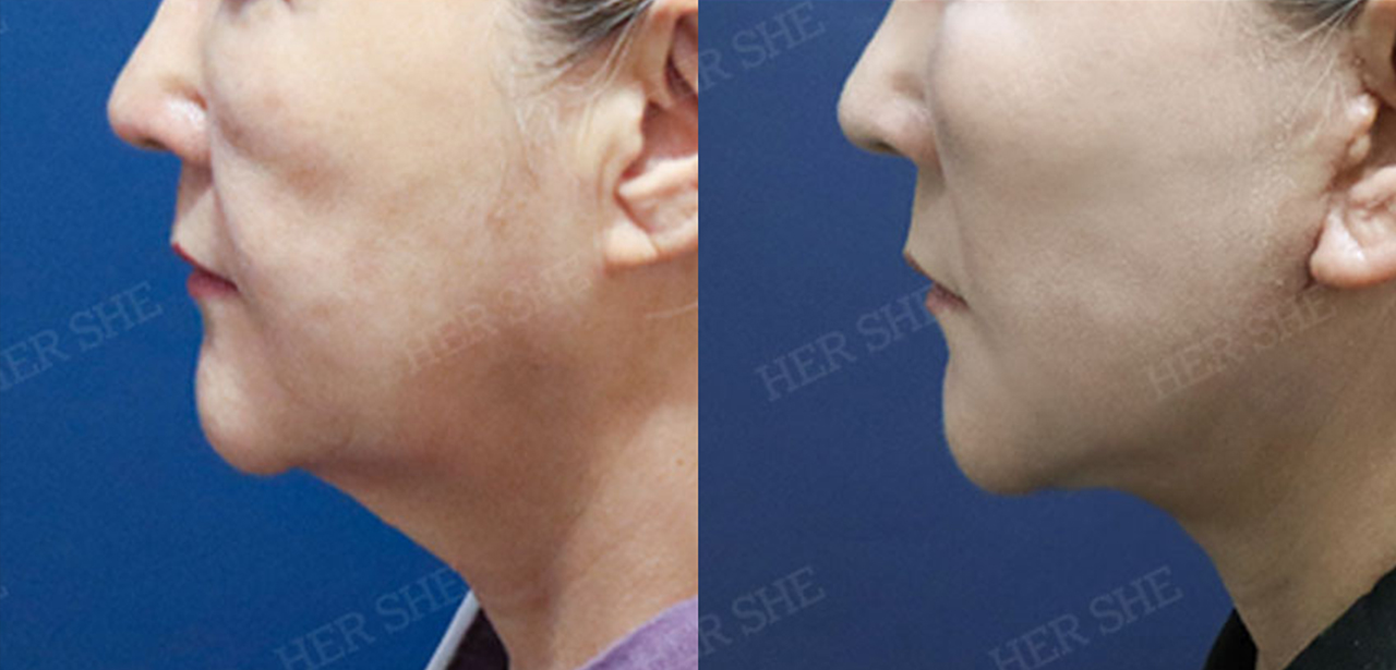 Shoulder Contouring Before & After Comparison
