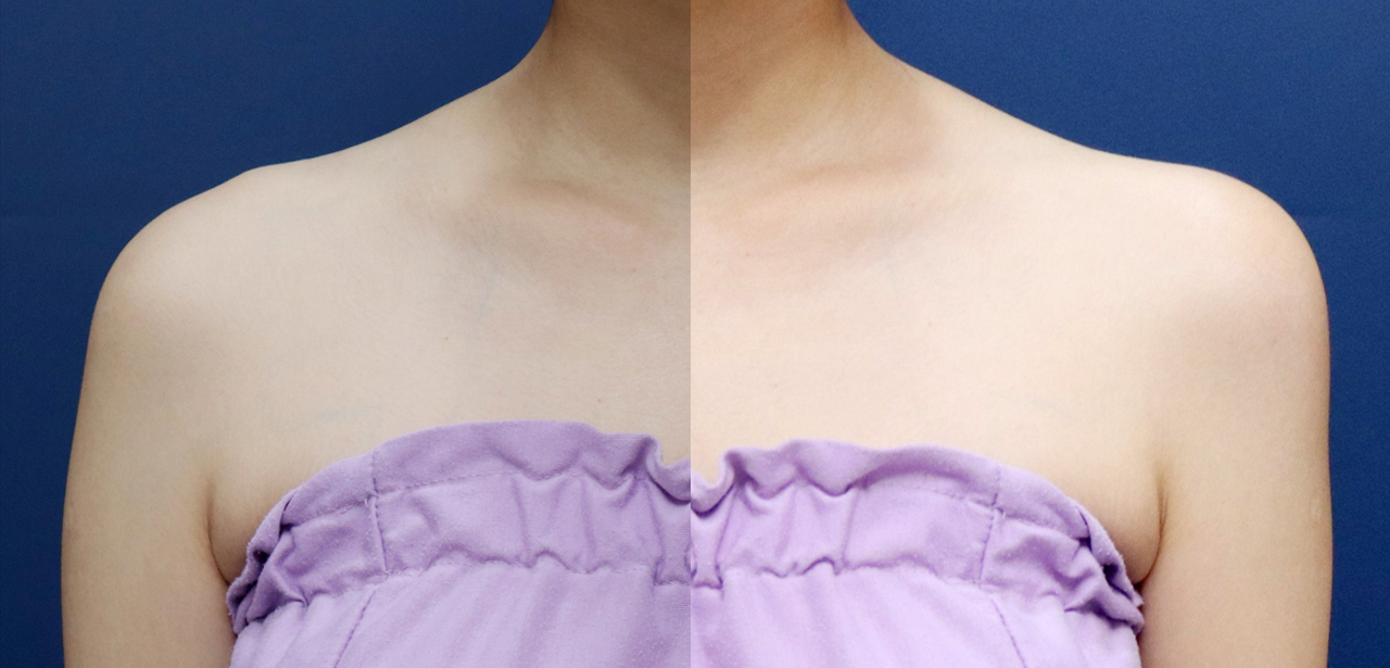 Shoulder surgery before and after comparison