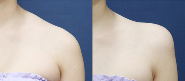Traptox before and after