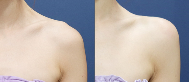 Shoulder filler with traptox before and after