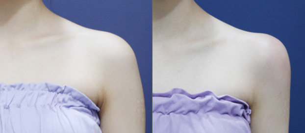 Total upper body line before and after