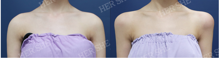 BEFORE & AFTER