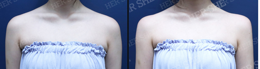 BEFORE & AFTER