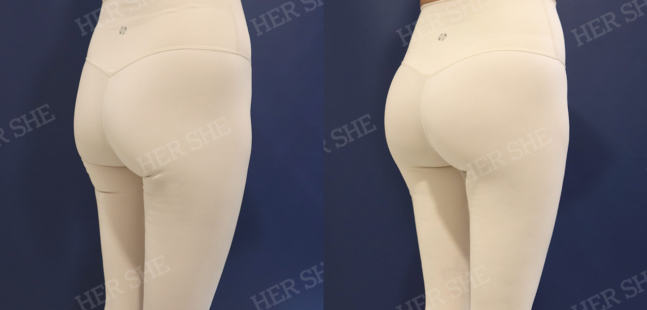Pelvic filler before-and-after comparison