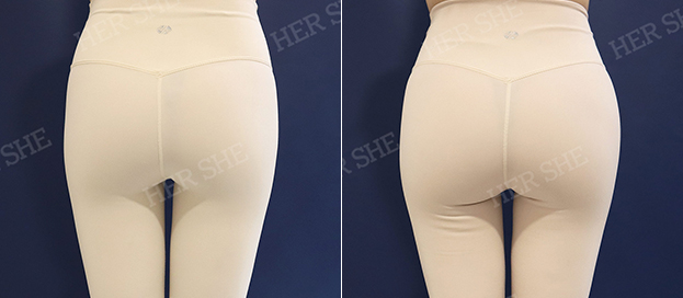 Butt filler before and after