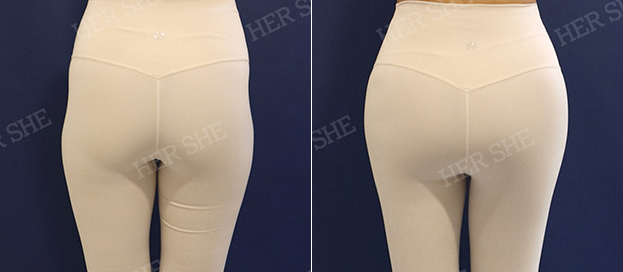 Hip-dip fat grafting before and after
