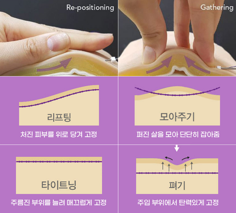 Lifting Expertise from Developing the Patented Epiticon Thread