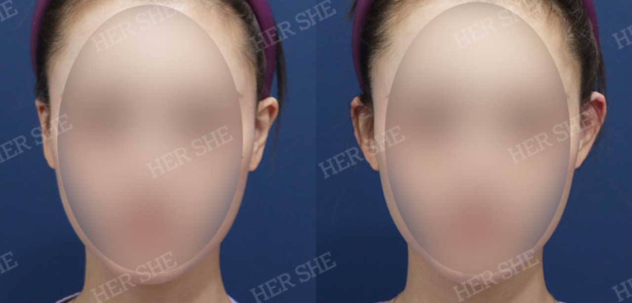Pelvic filler before-and-after comparison