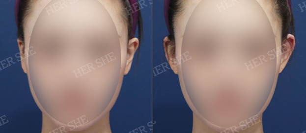 Protruding ear filler before and after