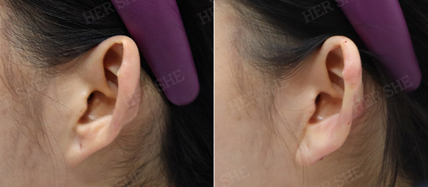 Earlobe filler before and after