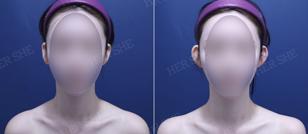 Protruding ear filler + shoulder filler before and after