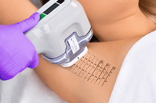 miraDry Level 5 Dual Pass treatment